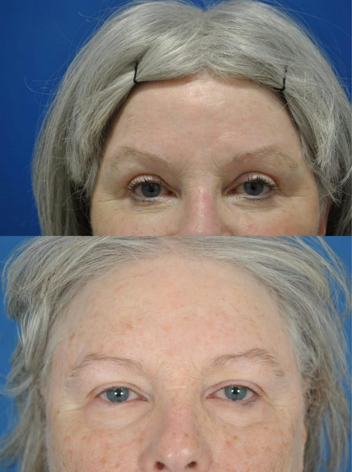 Eyelifts & Blepharoplasty Before & After Gallery - Patient 179611252 - Image 2