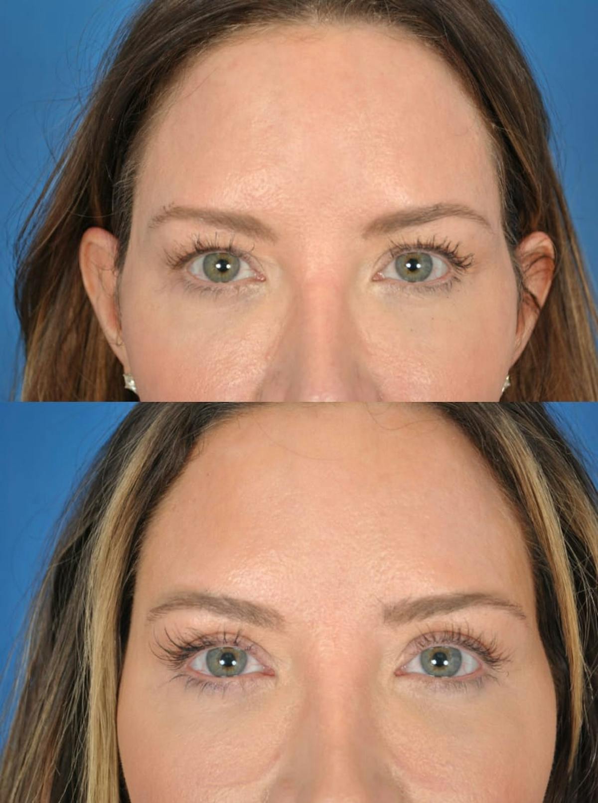 Eyelifts & Blepharoplasty Before & After Gallery - Patient 179611253 - Image 1