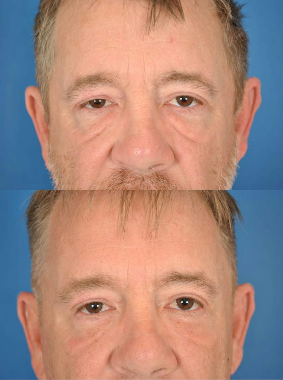 Eyelifts & Blepharoplasty Before & After Gallery - Patient 179611254 - Image 2