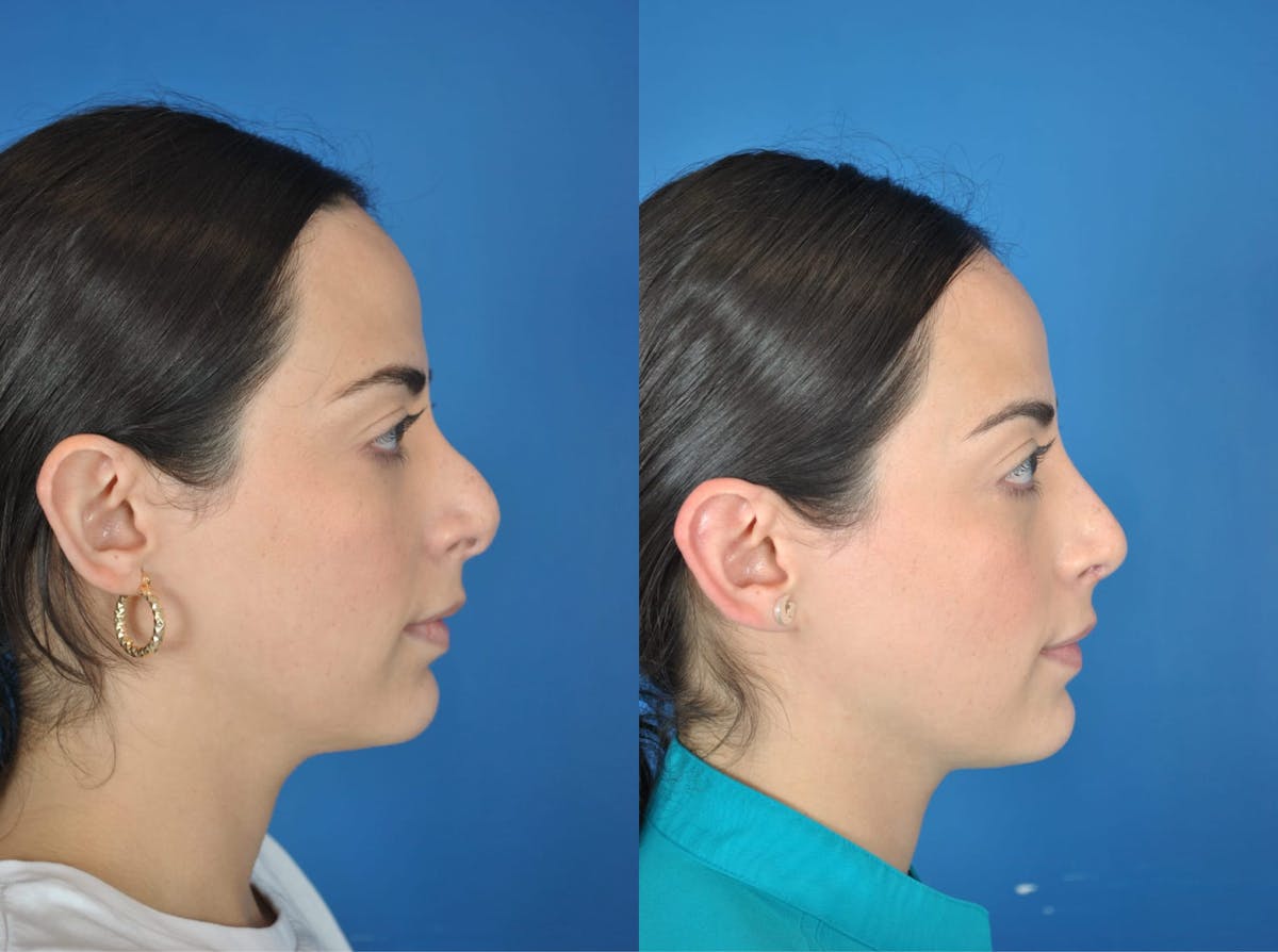 Rhinoplasty Before & After Gallery - Patient 179611907 - Image 1