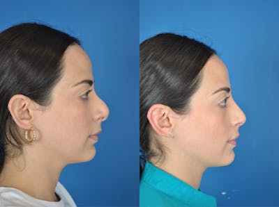 Rhinoplasty Before & After Gallery - Patient 179611907 - Image 1
