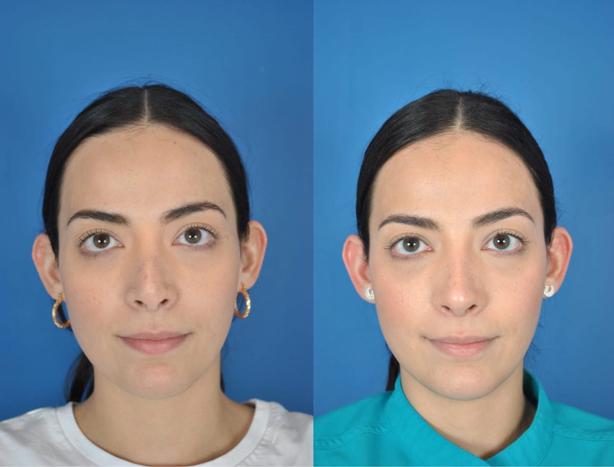 Rhinoplasty Before & After Gallery - Patient 179611907 - Image 2