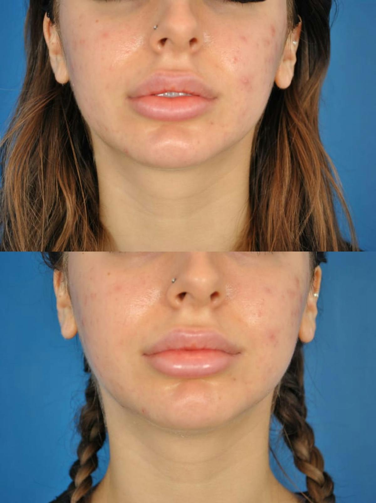 Buccal Lipectomy Before & After Gallery - Patient 179611915 - Image 1