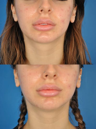 Buccal Lipectomy Before & After Gallery - Patient 179611915 - Image 1