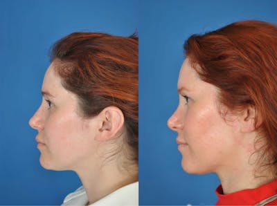 Buccal Lipectomy Before & After Gallery - Patient 179611916 - Image 1