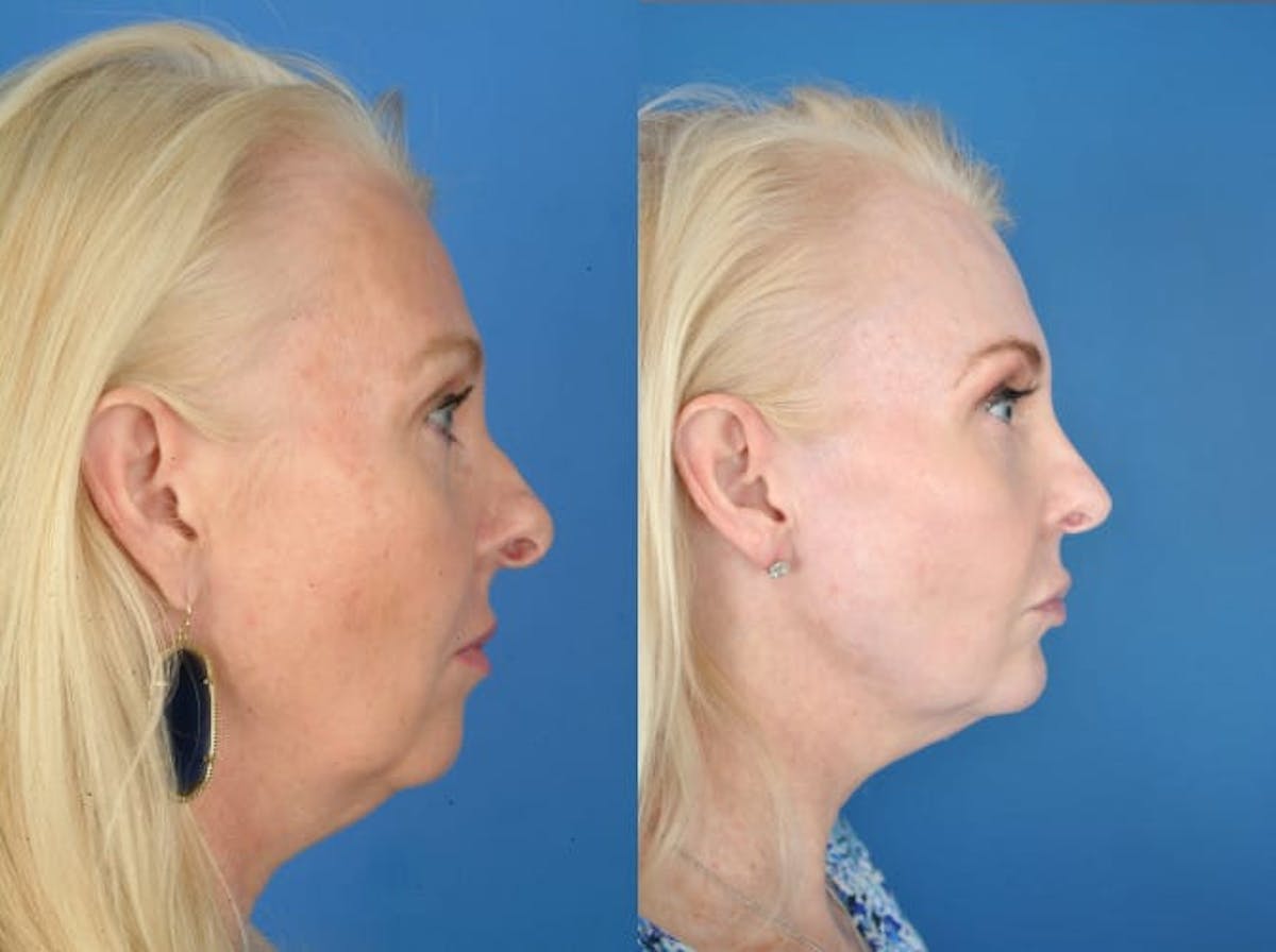 Rhinoplasty Before & After Gallery - Patient 179617646 - Image 2