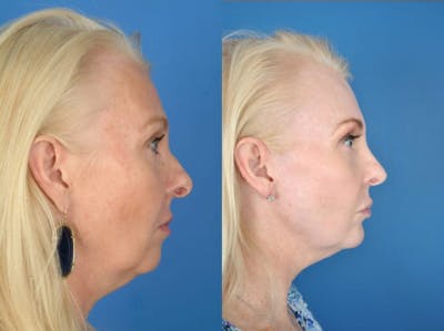 Rhinoplasty Before & After Gallery - Patient 179617646 - Image 1