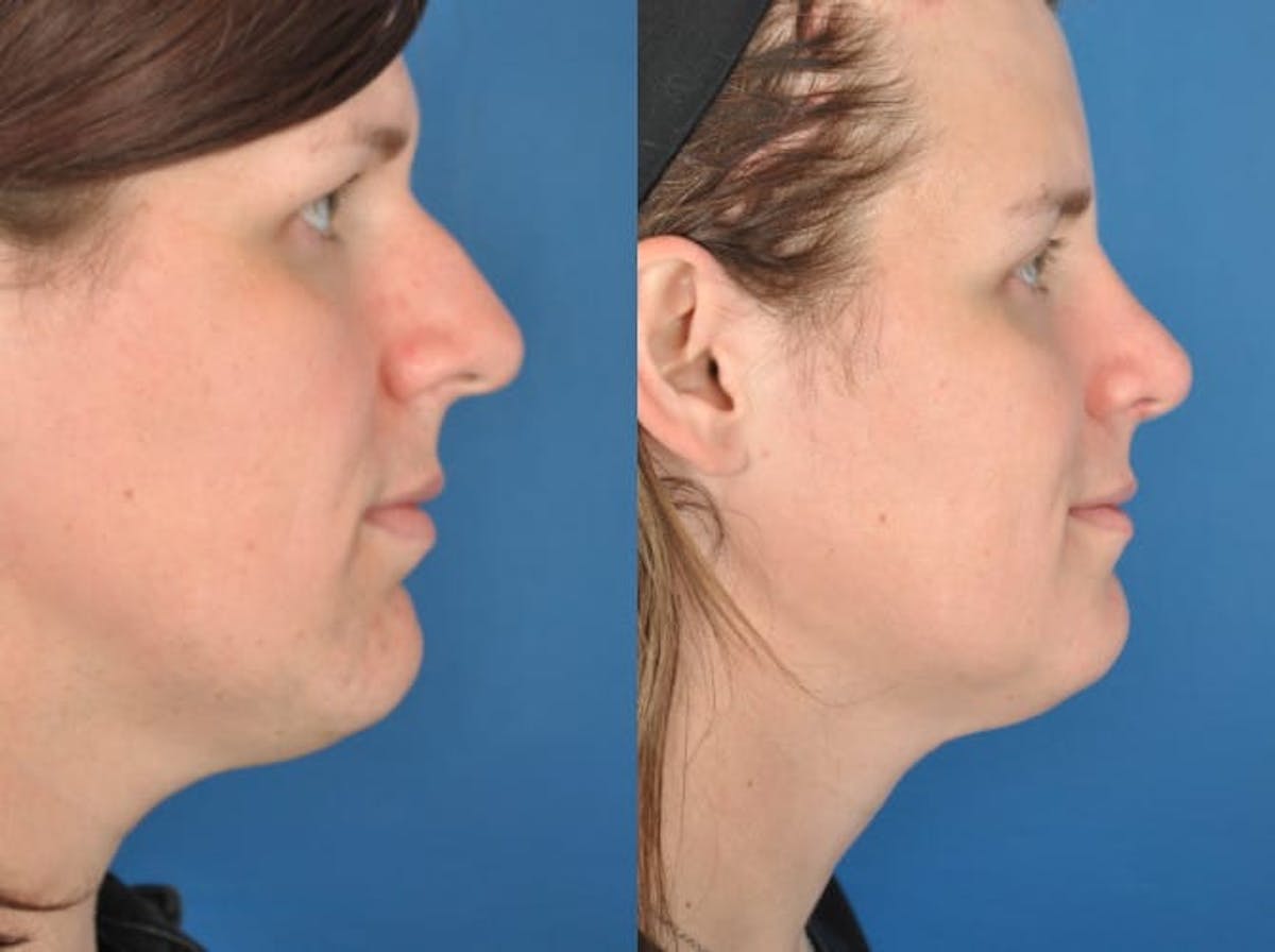 Rhinoplasty Before & After Gallery - Patient 179617647 - Image 1