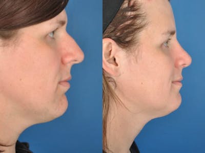 Rhinoplasty Before & After Gallery - Patient 179617647 - Image 1