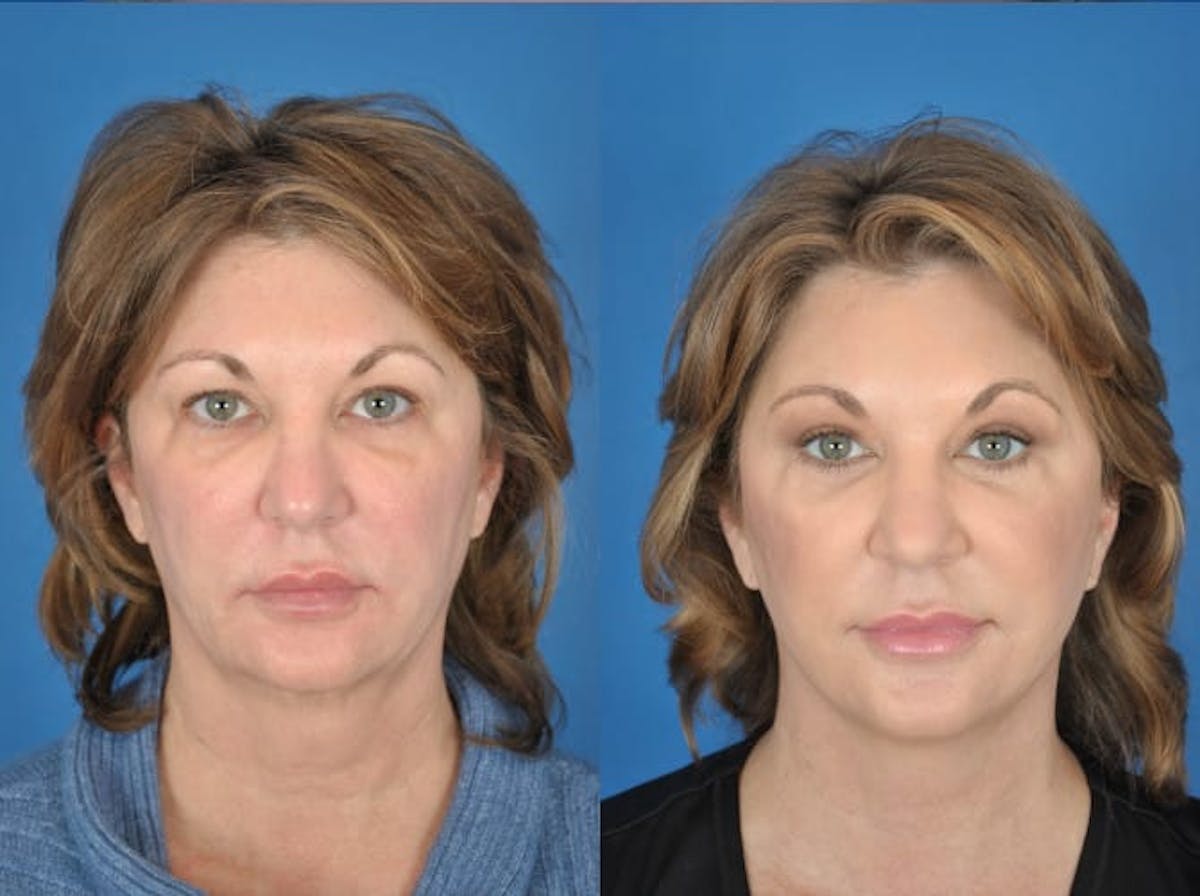 Facelifts Before & After Gallery - Patient 179617648 - Image 1
