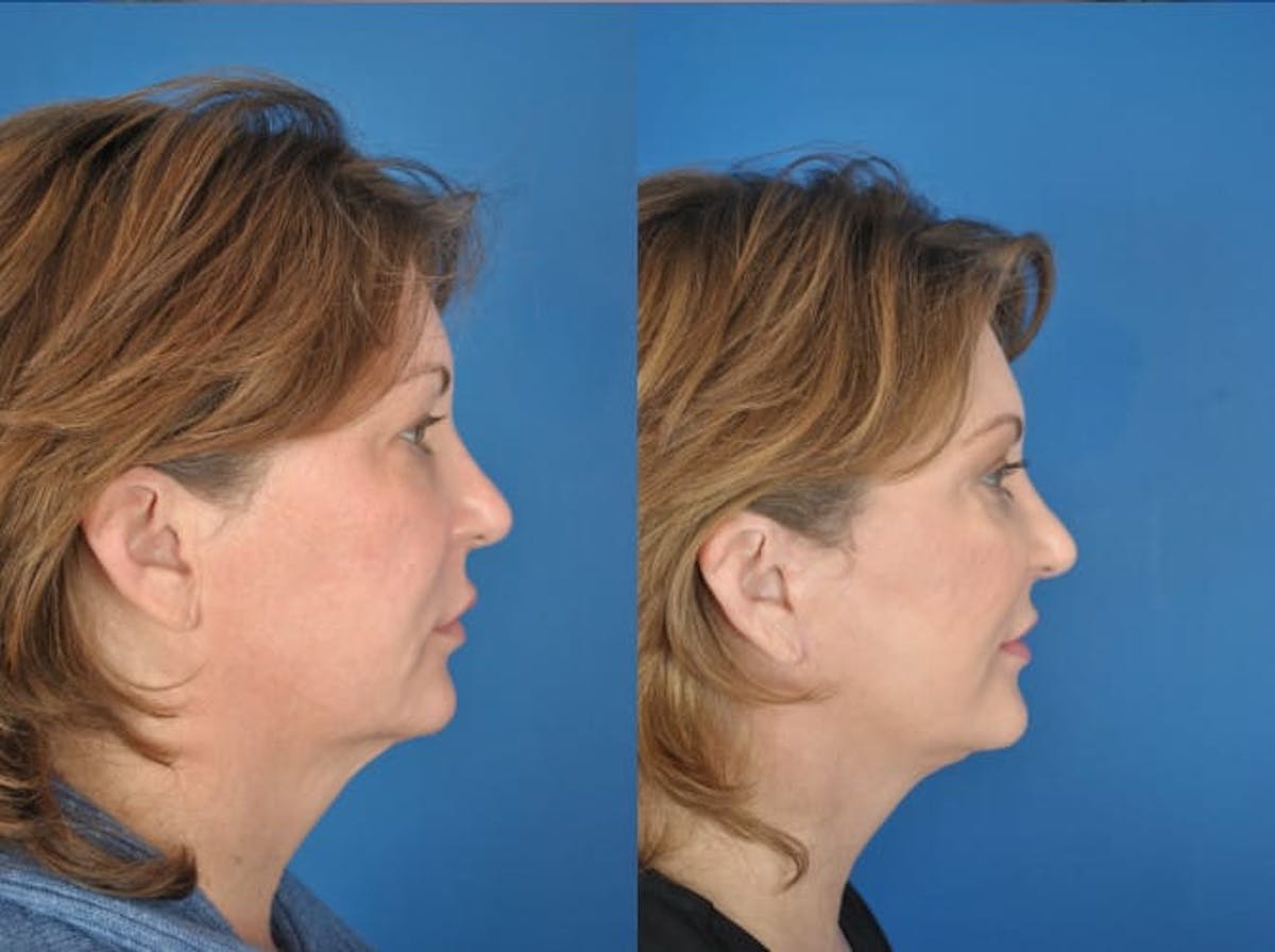 Facelifts Before & After Gallery - Patient 179617648 - Image 2