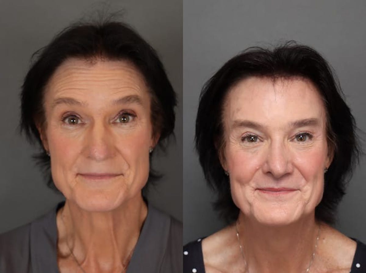 Lip Lifts Before & After Gallery - Patient 179617649 - Image 1