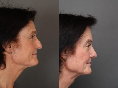 Rhinoplasty Before & After Gallery - Patient 179617650 - Image 1