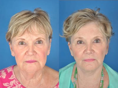 Facelifts Before & After Gallery - Patient 179618159 - Image 1