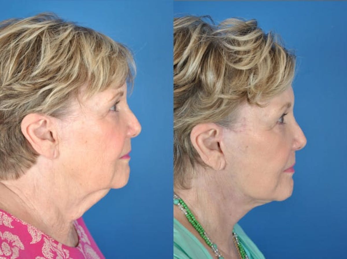 Facelifts Before & After Gallery - Patient 179618159 - Image 2