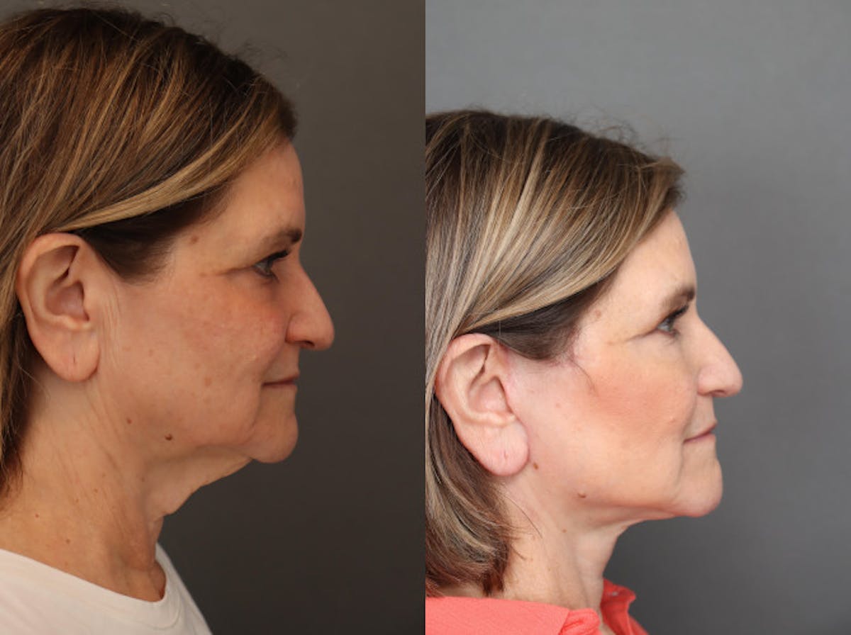 Facelifts Before & After Gallery - Patient 348592 - Image 2
