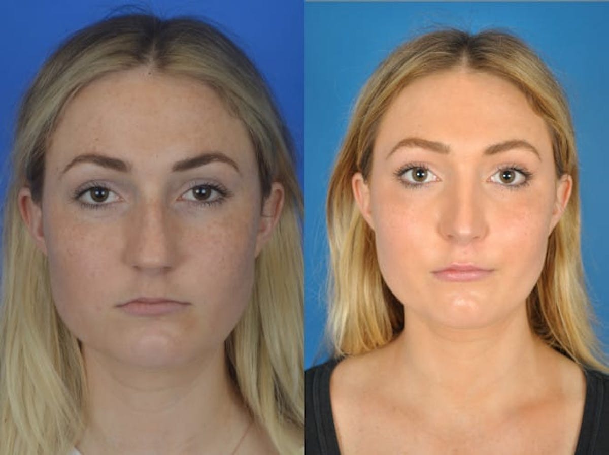 Rhinoplasty Before & After Gallery - Patient 179618248 - Image 2