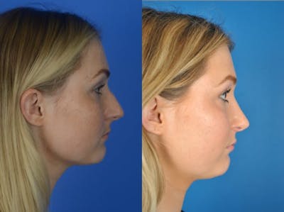 Rhinoplasty Before & After Gallery - Patient 179618248 - Image 1