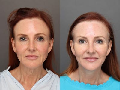 Facelifts Before & After Gallery - Patient 179618404 - Image 1