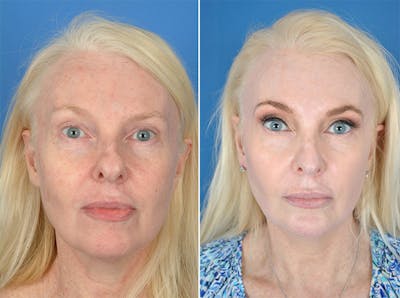 Laser Skin Resurfacing Before & After Gallery - Patient 179735209 - Image 1