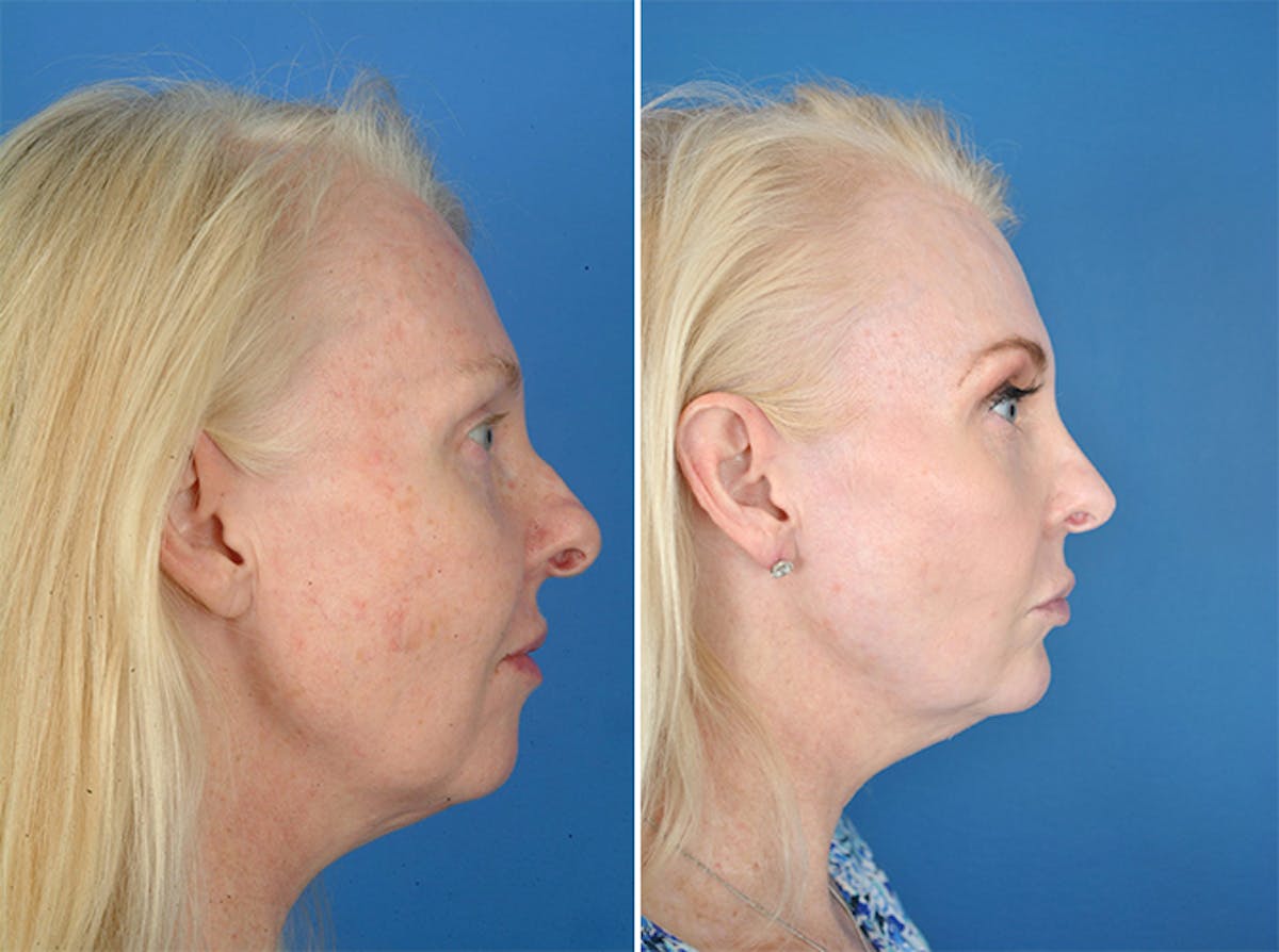 Laser Skin Resurfacing Before & After Gallery - Patient 179735209 - Image 2