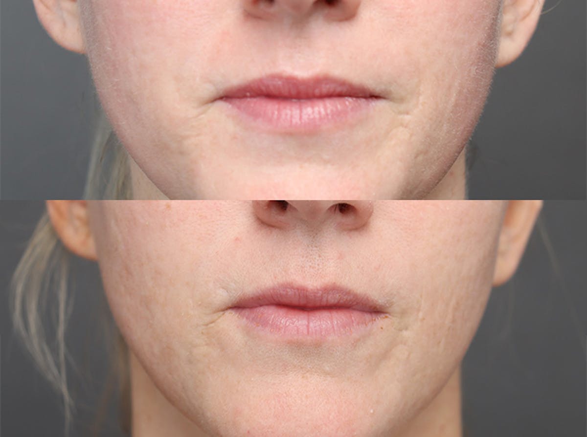 Laser Skin Resurfacing Before & After Gallery - Patient 179735807 - Image 2