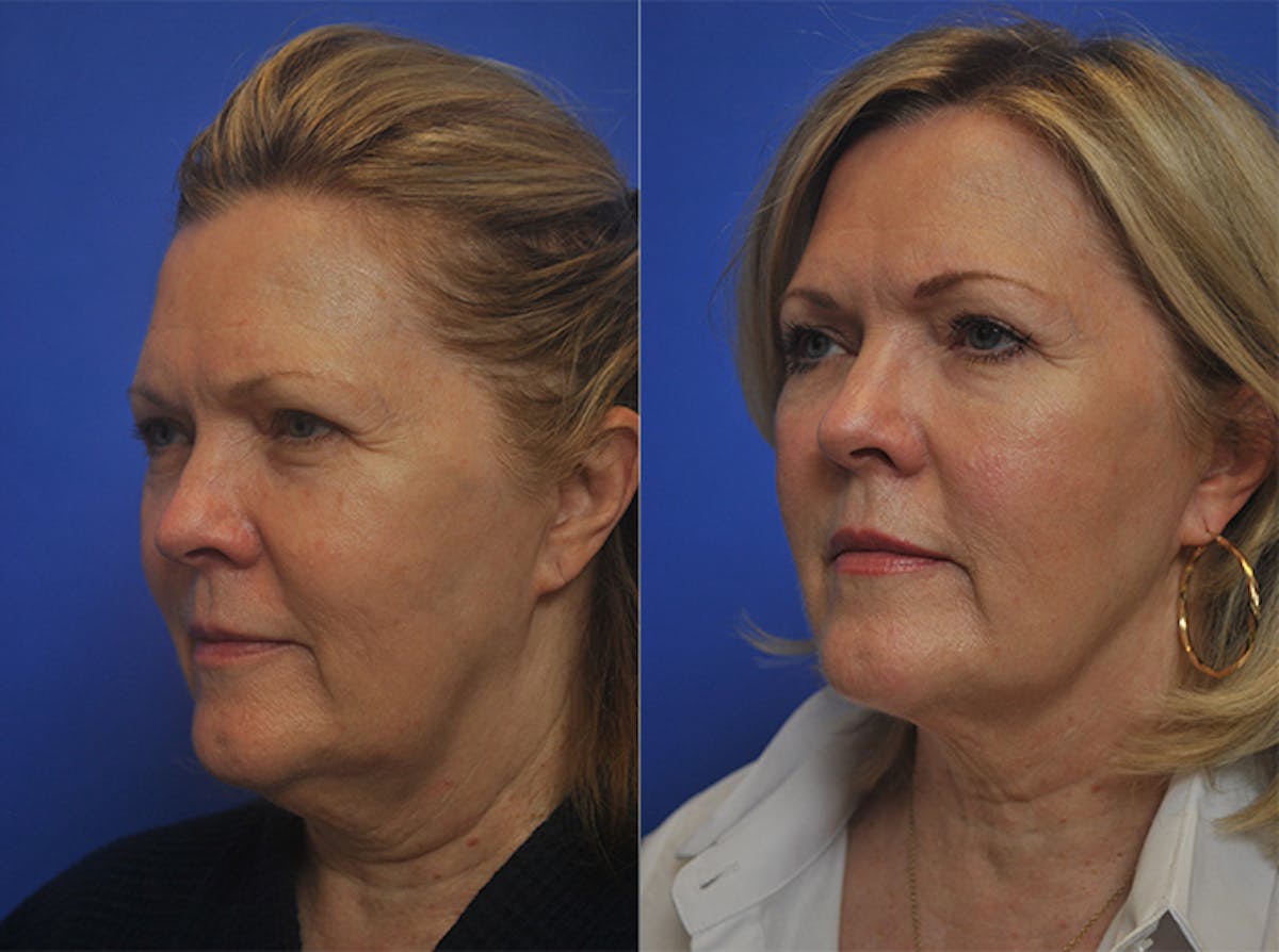 Embrace RF Before & After Gallery - Patient 179736861 - Image 1