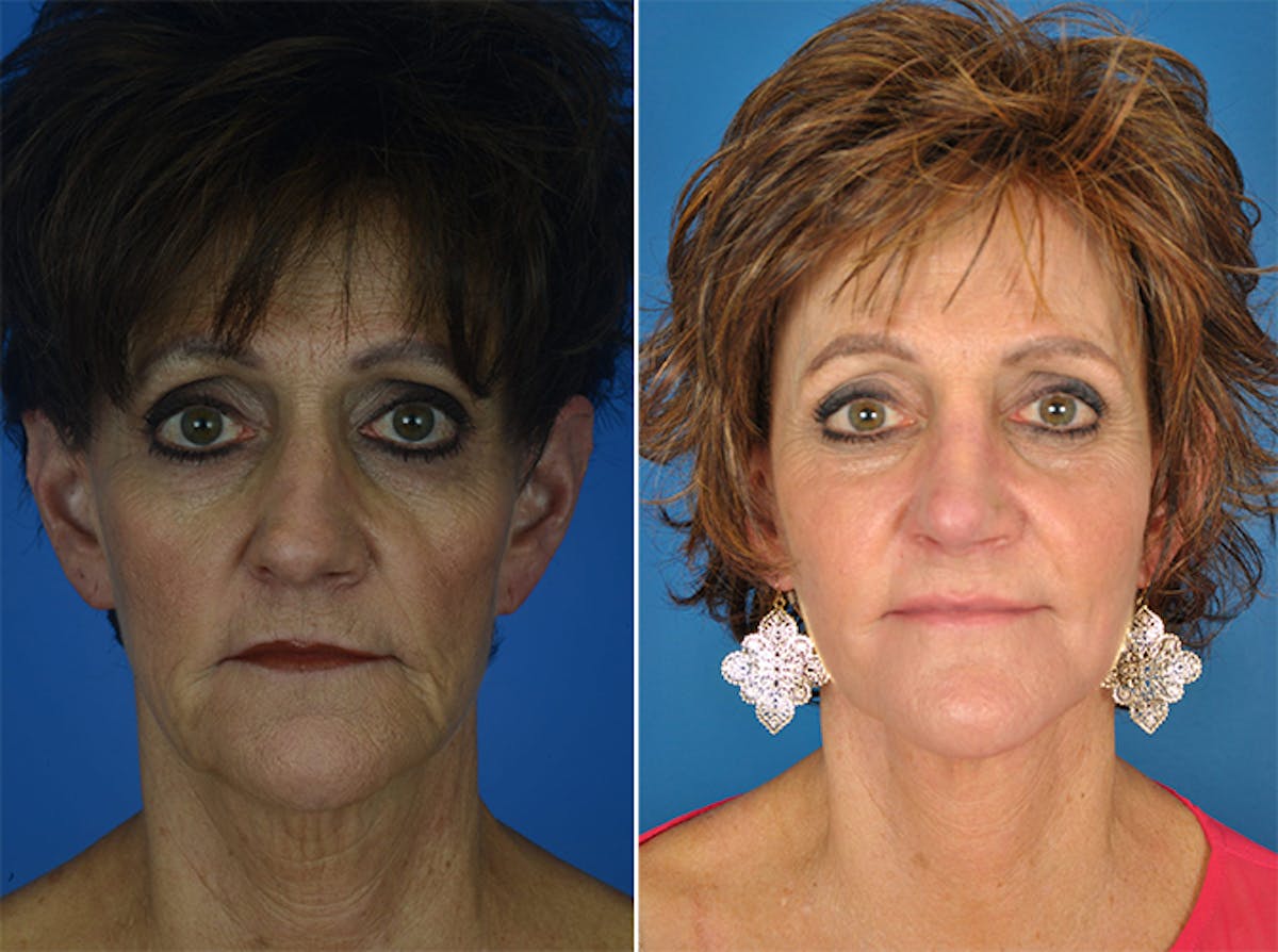 Facelifts Before & After Gallery - Patient 179737257 - Image 1