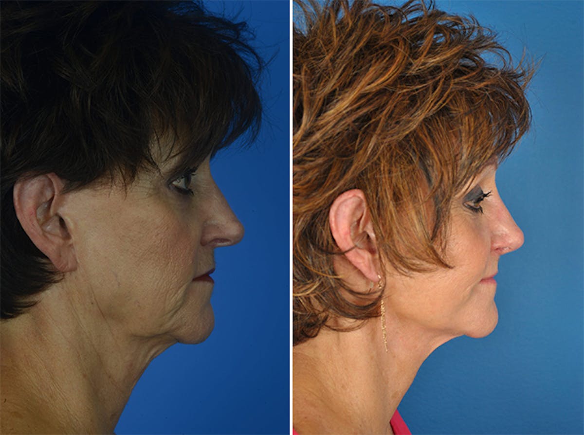 Facelifts Before & After Gallery - Patient 179737257 - Image 2