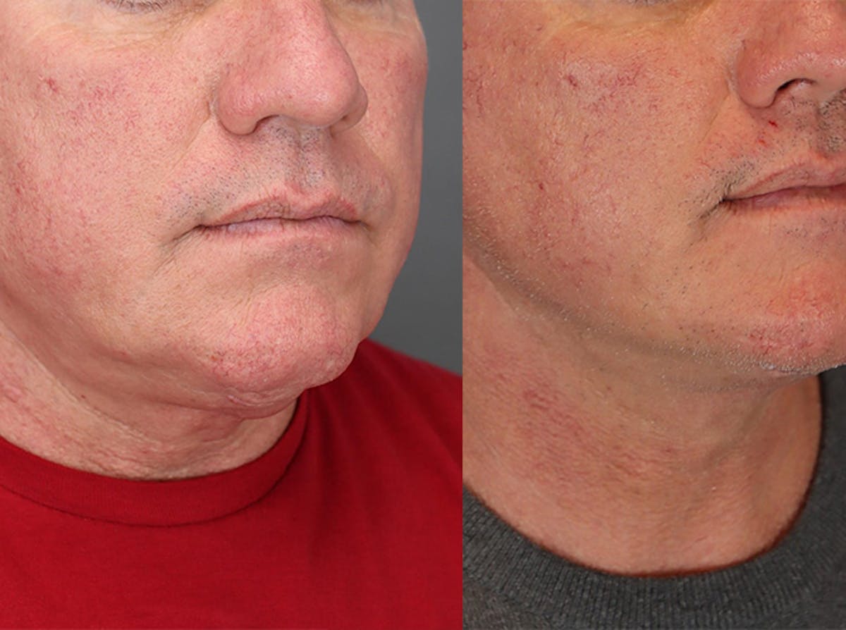 Facelifts Before & After Gallery - Patient 179737258 - Image 1