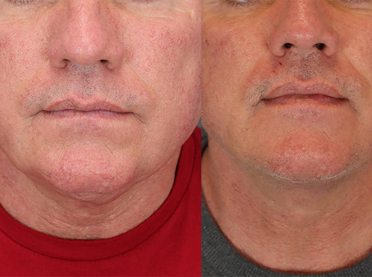 Facelifts Before & After Gallery - Patient 179737258 - Image 2