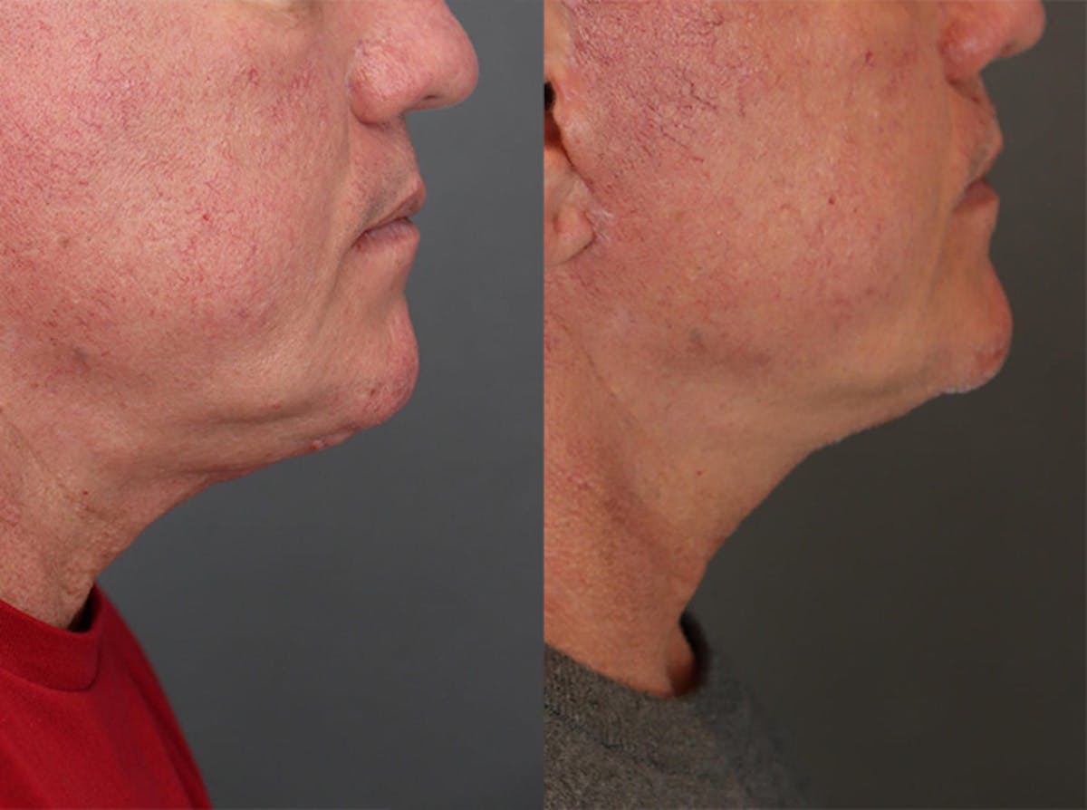 Facelifts Before & After Gallery - Patient 179737258 - Image 3
