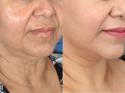 Facelifts Before & After Gallery - Patient 179737259 - Image 1