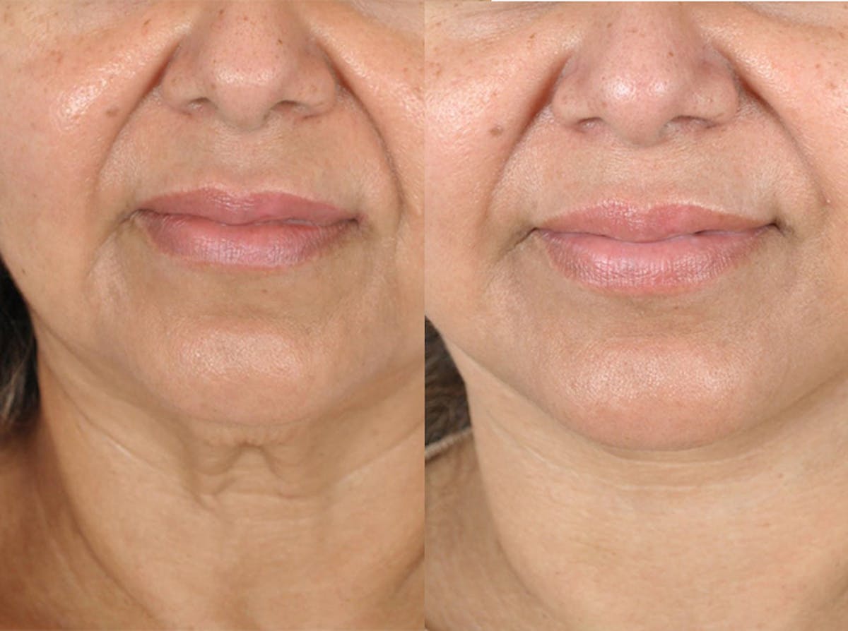 Facelifts Before & After Gallery - Patient 179737259 - Image 2