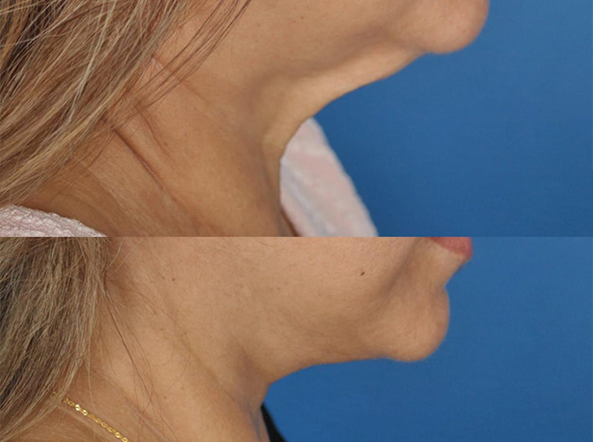 Facelifts Before & After Gallery - Patient 179737259 - Image 3