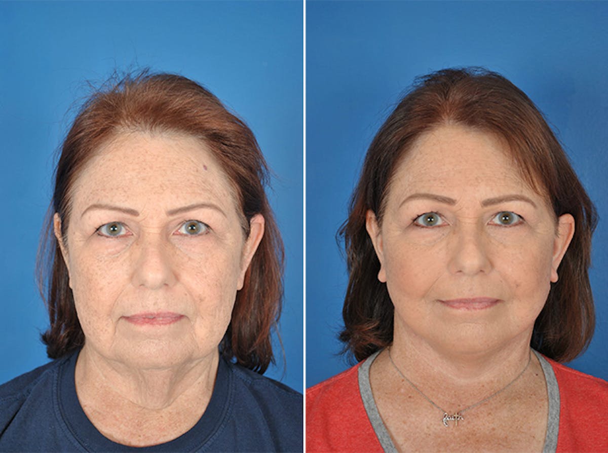 Facelifts Before & After Gallery - Patient 179737260 - Image 1