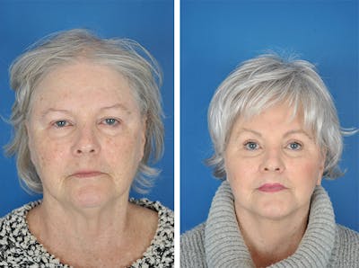 Facelifts Before & After Gallery - Patient 179737261 - Image 1