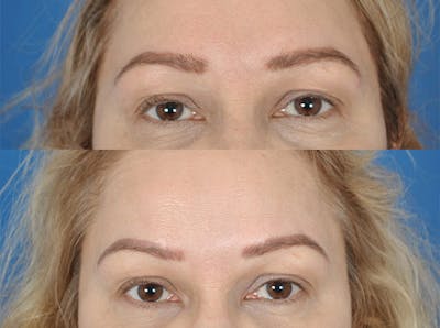 Hairline Advancement Before & After Gallery - Patient 180186273 - Image 1