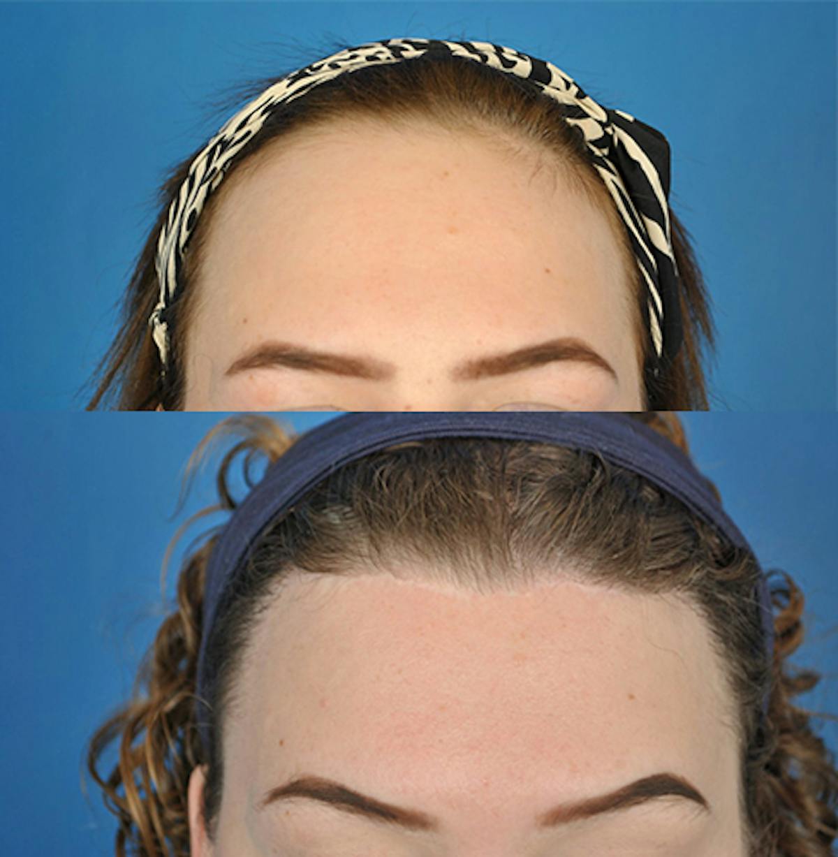 Hairline Advancement Before & After Gallery - Patient 180186338 - Image 3