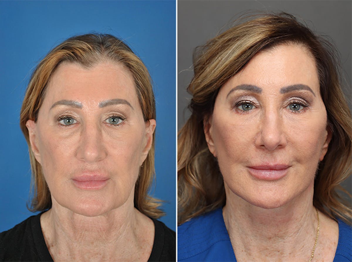 Facelifts Before & After Gallery - Patient 179742312 - Image 1