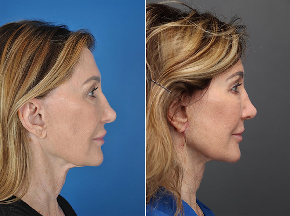 Facelifts Before & After Gallery - Patient 179742312 - Image 2