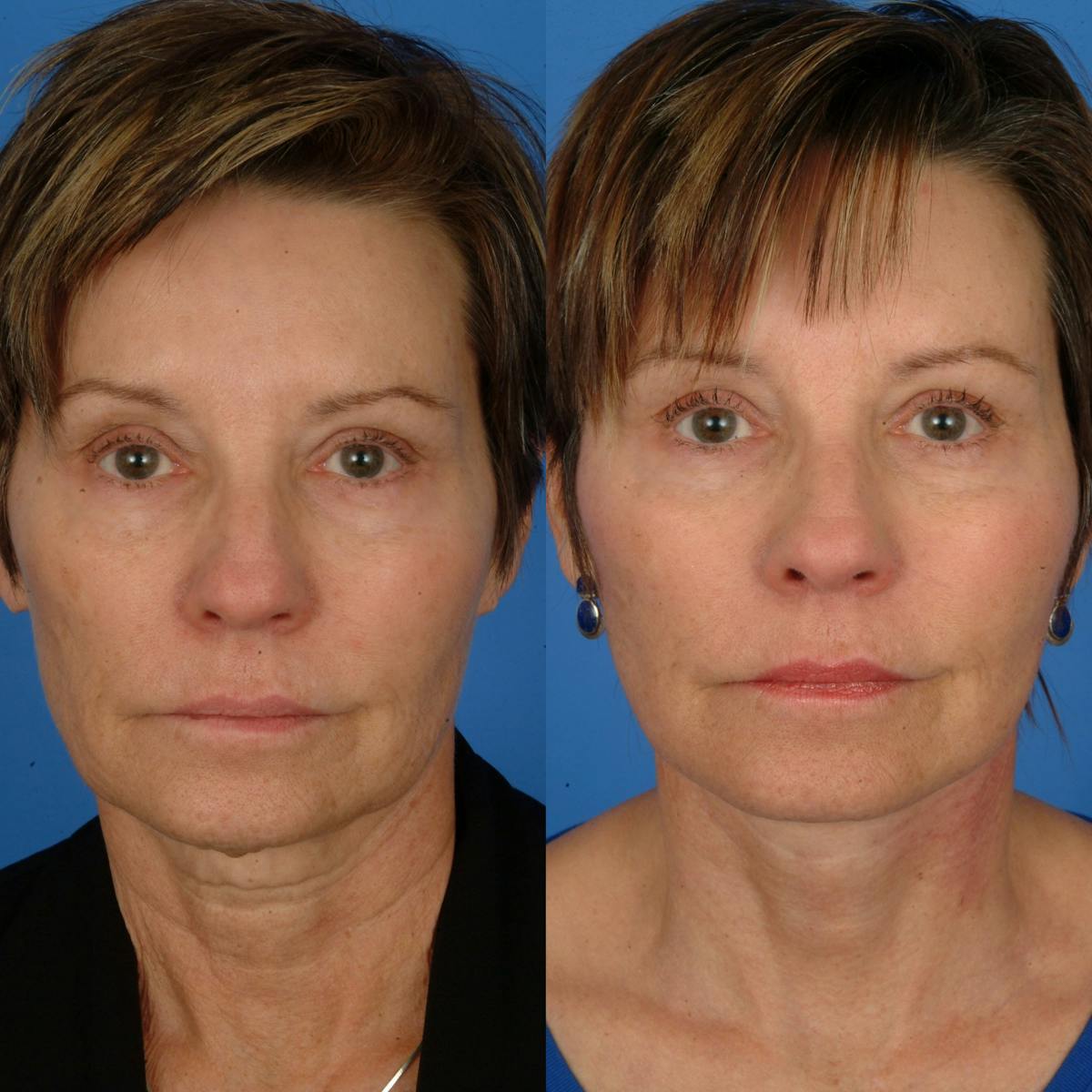 Facelifts Before & After Gallery - Patient 179742562 - Image 1