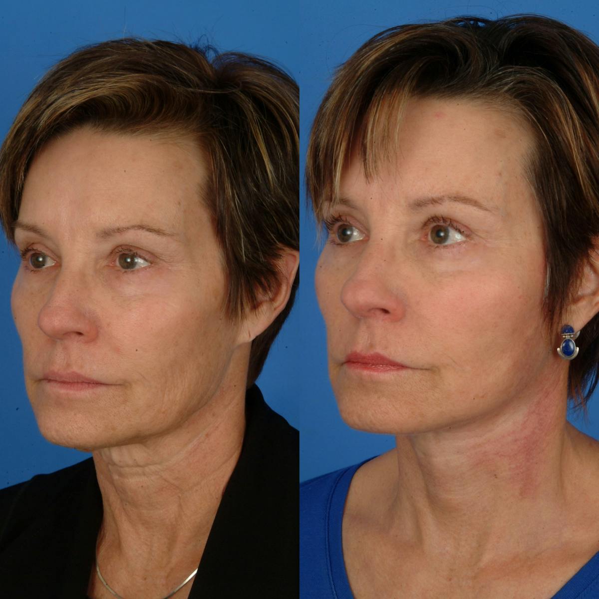 Facelifts Before & After Gallery - Patient 179742562 - Image 2