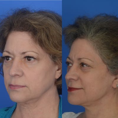 Facelifts Before & After Gallery - Patient 179742730 - Image 1