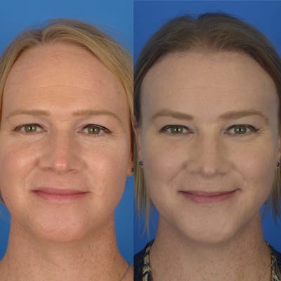 Facial Feminization Before & After Gallery - Patient 179746139 - Image 1