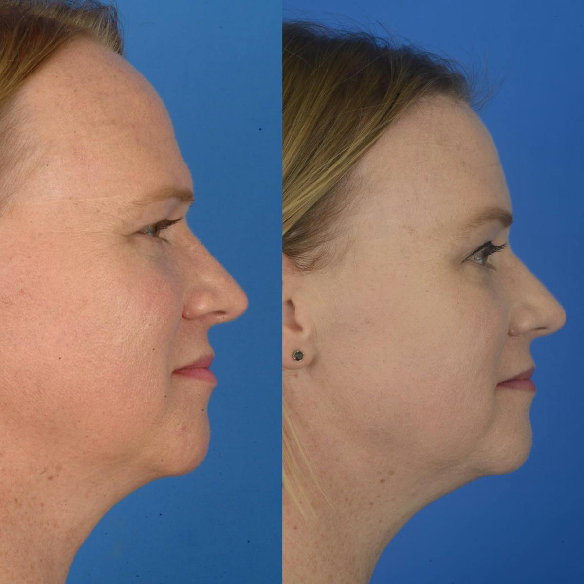 Facial Feminization Before & After Gallery - Patient 179746139 - Image 2