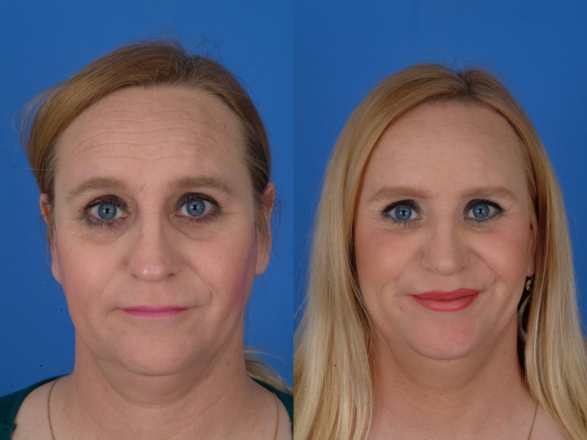 Facial Feminization Before & After Gallery - Patient 179746196 - Image 2