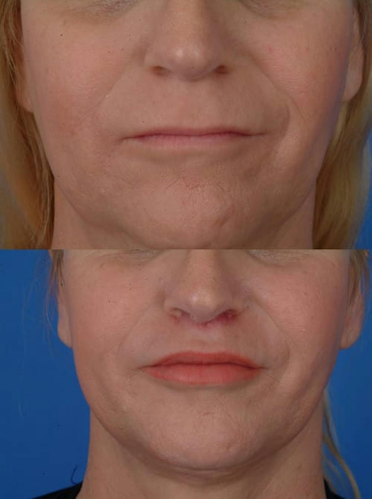Facial Feminization Before & After Gallery - Patient 179746196 - Image 5