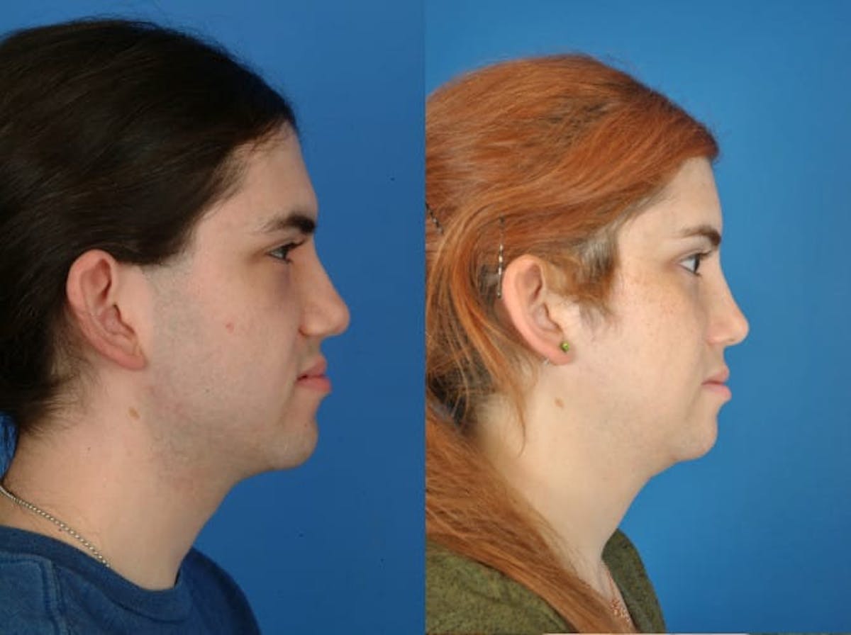 Facial Feminization Before & After Gallery - Patient 179747482 - Image 2