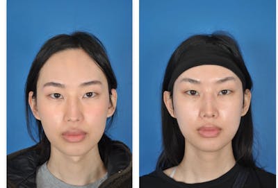Facial Feminization Before & After Gallery - Patient 179747965 - Image 1